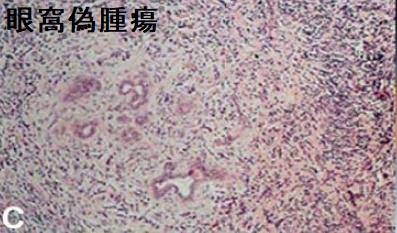 眼窩偽腫瘍 組織像 眼窩偽腫瘍 組織像