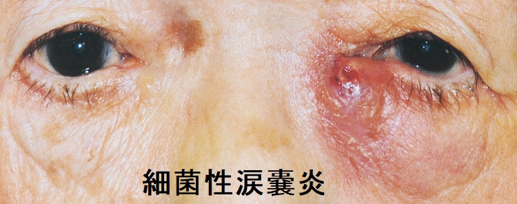 細菌性涙嚢炎・涙腺炎 細菌性涙嚢炎・涙腺炎