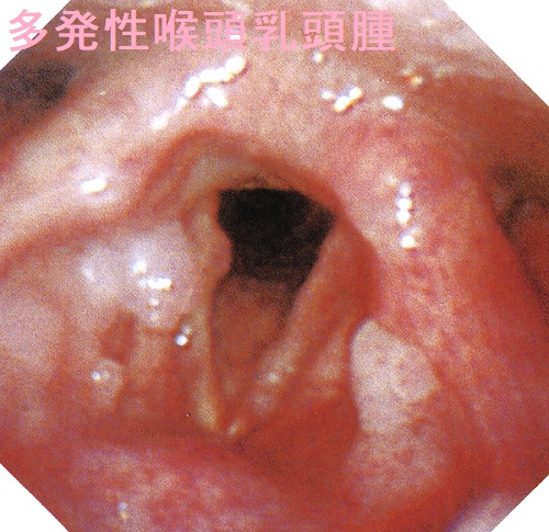 喉頭乳頭腫 多発性 喉頭乳頭腫 多発性