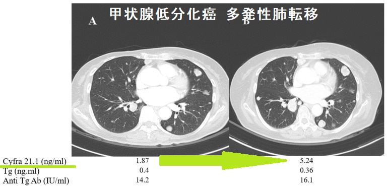 甲状腺癌腫瘍マーカー(サイログロブリン,p53抗体,SCC,CA125,CA19