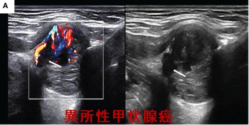 異所性甲状腺癌 異所性甲状腺癌