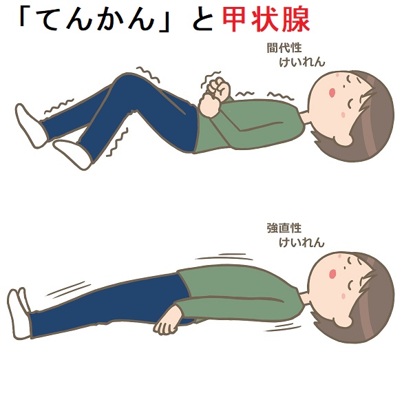 「てんかん」と甲状腺 「てんかん」と甲状腺