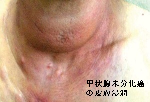 甲状腺未分化癌の皮膚浸潤 甲状腺未分化癌の皮膚浸潤