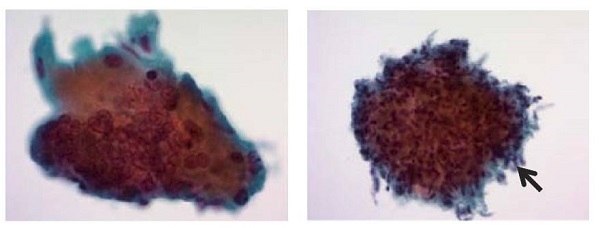 甲状腺結核 穿刺細胞診 甲状腺結核 穿刺細胞診