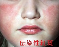 伝染性紅斑と甲状腺 伝染性紅斑と甲状腺