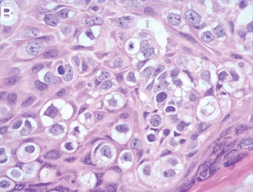 特徴的なPaget細胞 特徴的なPaget細胞