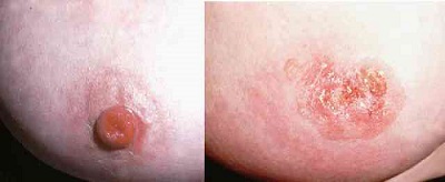 乳房パジェット病(Paget病) 乳房パジェット病(Paget病)