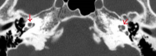 ペンドレッド症候群 蝸牛頂 CT画像 ペンドレッド症候群 前庭水管 CT画像