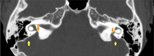 ペンドレッド症候群 前庭水管 CT画像 ペンドレッド症候群 前庭水管 CT画像