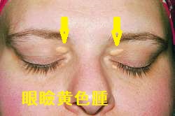 眼瞼黄色腫 眼瞼黄色腫