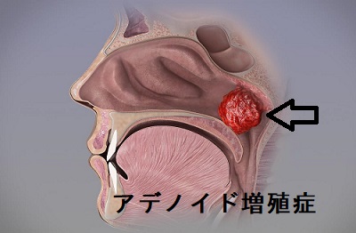 アデノイド増殖症 アデノイド増殖症