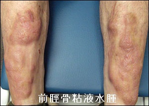前脛骨粘液水腫 前脛骨粘液水腫
