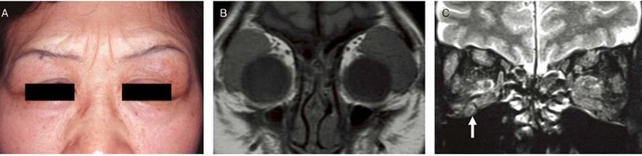 IgG4関連眼症 IgG4関連眼症