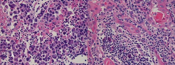 胸腺のホジキンリンパ腫 胸腺のホジキンリンパ腫