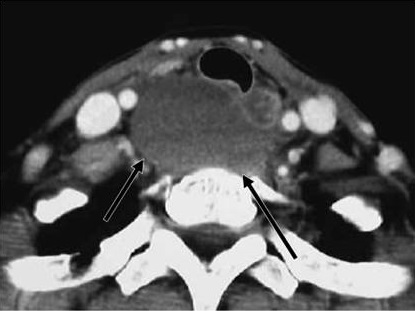 副甲状腺の破裂による深頸部血腫 副甲状腺の破裂による深頸部血腫