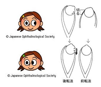 バセドウ病眼症(甲状腺眼症)の手術治療 バセドウ病眼症(甲状腺眼症)の手術治療