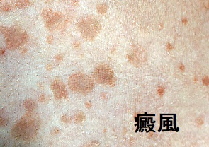 癜風(でんぷう) 癜風(でんぷう)