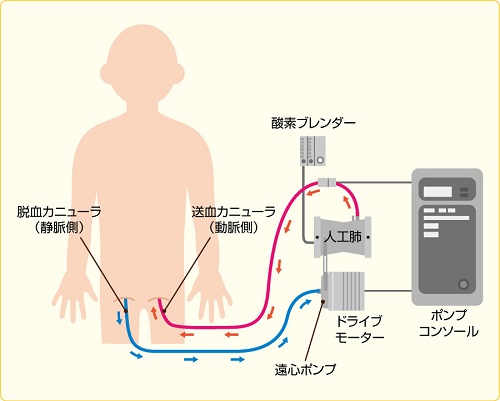 経皮的心肺補助法(PCPS) 経皮的心肺補助法(PCPS)