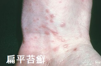 扁平苔癬 扁平苔癬