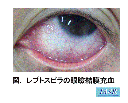 レプトスピラ症 結膜充血 レプトスピラ症 結膜充血