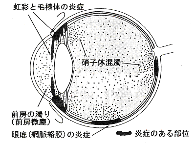 ベーチェット病のぶどう膜炎 ベーチェット病のぶどう膜炎