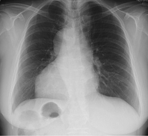 内臓逆位 胸X-p 内臓逆位 胸X-p