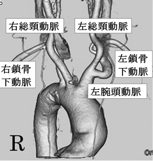 内臓逆位 3次元CT 内臓逆位 3次元CT