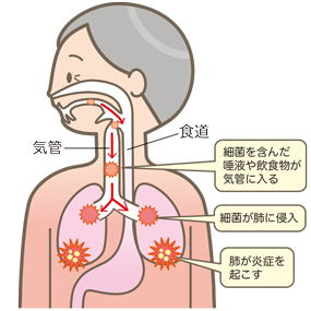誤嚥性肺炎・びまん性誤嚥性細気管支炎と甲状腺 誤嚥性肺炎・びまん性誤嚥性細気管支炎と甲状腺