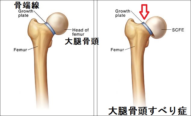 大腿骨頭すべり症 大腿骨頭すべり症