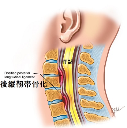 甲状腺と整形外科①(頸肩腕);コラーゲン,頚椎後縦靱帯骨化症
