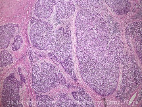 甲状腺の胸腺様分化を示す癌(CASTLE) 甲状腺の胸腺様分化を示す癌(CASTLE)
