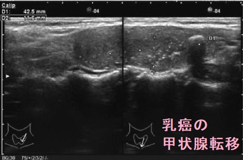 乳癌の甲状腺転移 超音波(エコー)画像 乳癌の甲状腺転移 超音波(エコー)画像