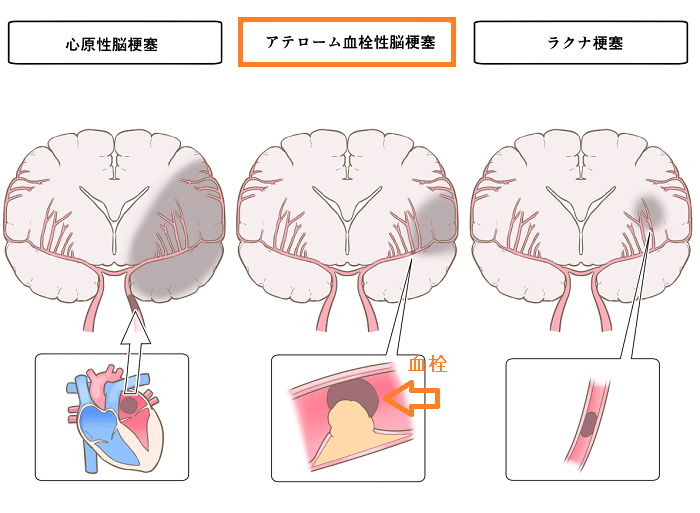 甲状腺機能低下症・バセドウ病と脳梗塞 (動脈硬化性脳梗塞) 甲状腺機能低下症・バセドウ病と脳梗塞 (動脈硬化性脳梗塞)
