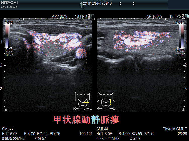 甲状腺動静脈瘻 超音波(エコー)画像 ドプラー 甲状腺動静脈瘻 超音波(エコー)画像 ドプラーモード