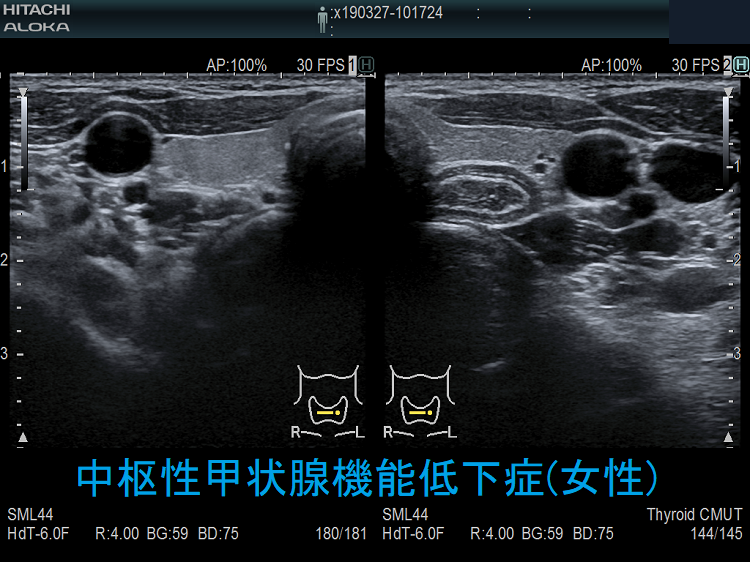 中枢性甲状腺機能低下症(女性) 超音波(エコー)画像 中枢性甲状腺機能低下症(女性) 超音波(エコー)画像