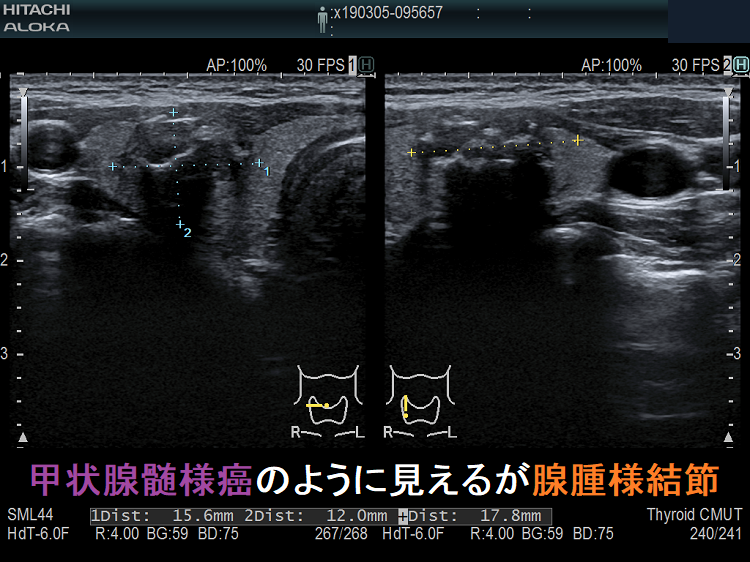 甲状腺髄様癌のように見えるが腺腫様結節 甲状腺髄様癌のように見えるが腺腫様結節