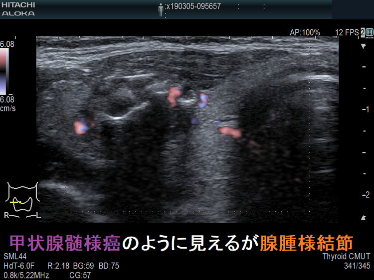 甲状腺髄様癌のように見えるが腺腫様結節(拡大) 甲状腺髄様癌のように見えるが腺腫様結節(拡大)