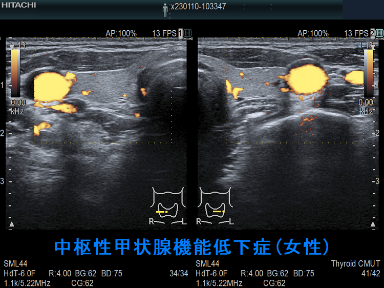中枢性甲状腺機能低下症(女性) ドプラーモード 中枢性甲状腺機能低下症(女性) ドプラーモード