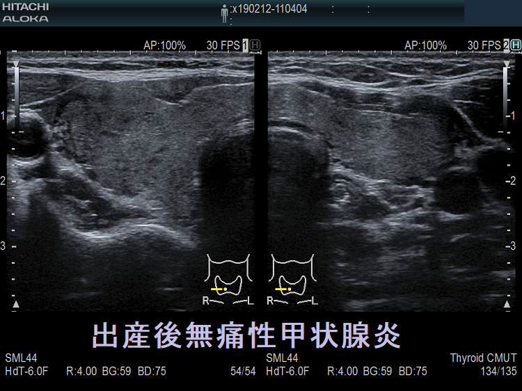 出産後無痛性甲状腺炎 超音波(エコー)画像 出産後無痛性甲状腺炎 超音波(エコー)画像