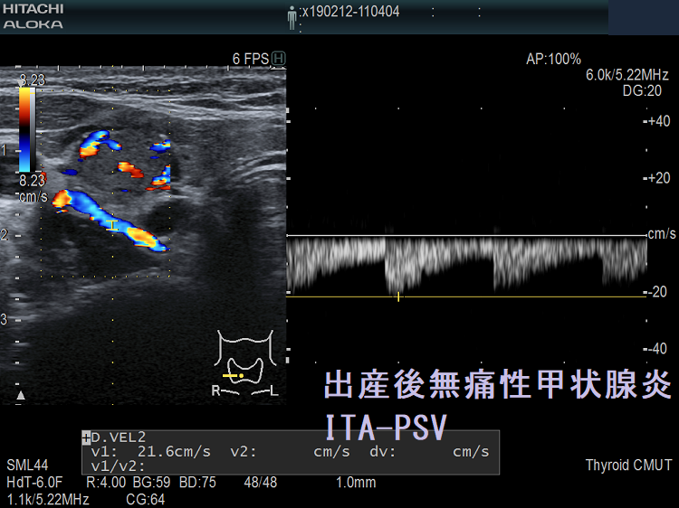出産後無痛性甲状腺炎 超音波(エコー)画像(ITA-PSV) 出産後無痛性甲状腺炎 超音波(エコー)画像(ITA-PSV)