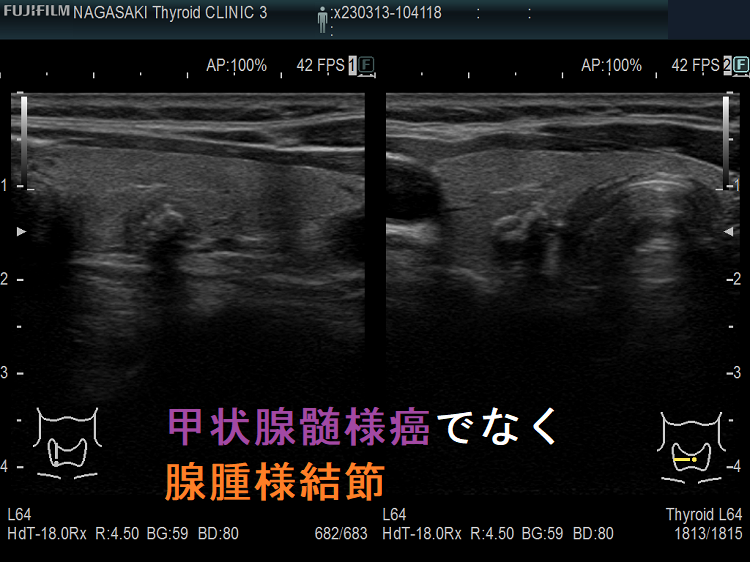 甲状腺髄様癌でなく腺腫様結節 甲状腺髄様癌でなく腺腫様結節