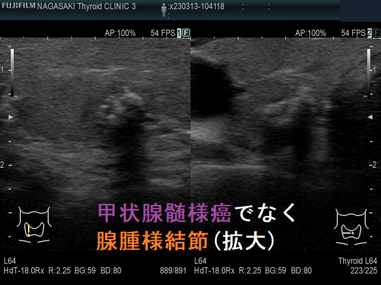 甲状腺髄様癌でなく腺腫様結節(拡大) 甲状腺髄様癌でなく腺腫様結節(拡大)