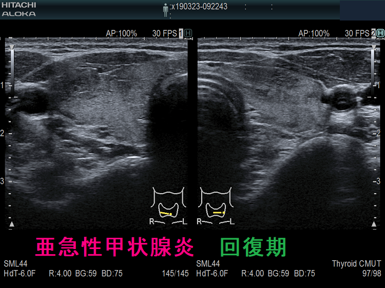 亜急性甲状腺炎 回復期 超音波(エコー)画像 亜急性甲状腺炎 回復期 超音波(エコー)画像