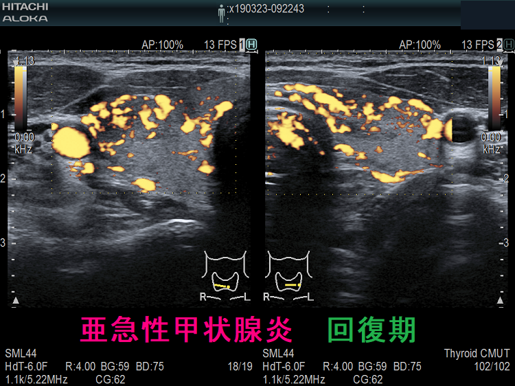 亜急性甲状腺炎 回復期 超音波(エコー)画像 血流 亜急性甲状腺 回復期 超音波(エコー)画像 血流