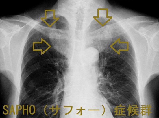 掌蹠膿疱症(しょうせきのうほうしょう)・SAPHO（サフォー