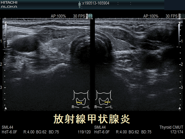 放射線甲状腺炎 超音波(エコー)画像 放射線甲状腺炎 超音波(エコー)画像