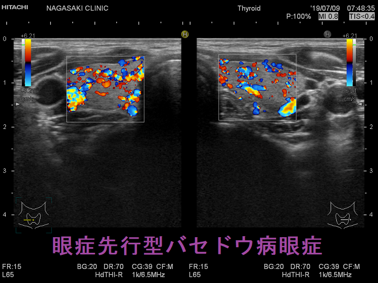 眼症先行型バセドウ病眼症 ドプラーモード 眼症先行型バセドウ病眼症 ドプラーモード