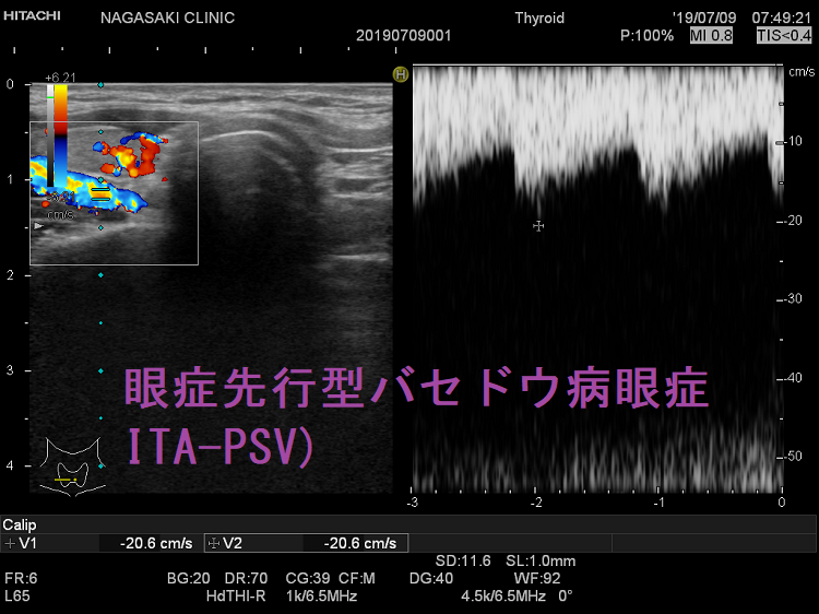 眼症先行型バセドウ病眼症 下甲状腺動脈の血流速度(ITA-PSV) 眼症先行型バセドウ病眼症 下甲状腺動脈の血流速度(ITA-PSV)