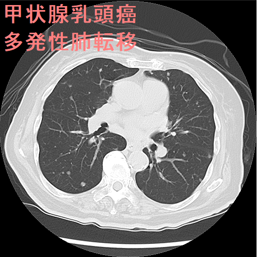 甲状腺乳頭癌 多発性肺転移 CT画像 甲状腺乳頭癌 多発性肺転移 CT画像