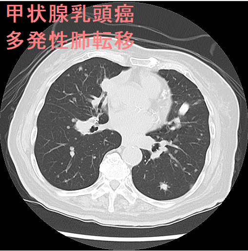 甲状腺乳頭癌 多発性肺転移 CT画像2 甲状腺乳頭癌 多発性肺転移 CT画像2